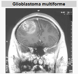 glioblastoma