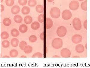 macrocytosis