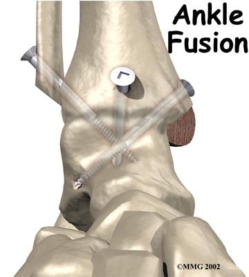 ankle fusion