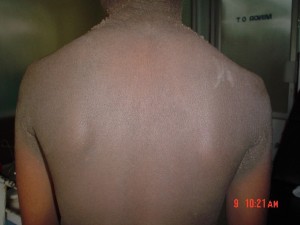 acanthosis-nigricans