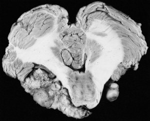 Acoustic Neuroma