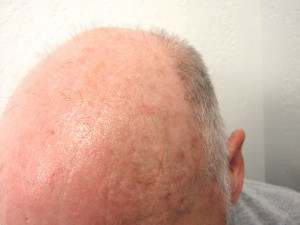 Actinic_Keratosis