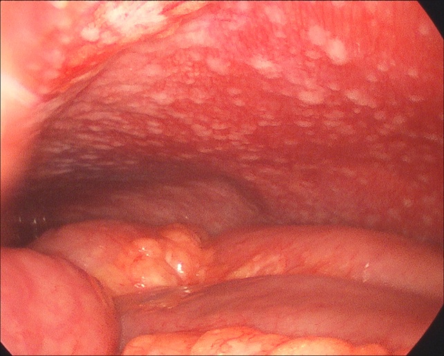 Appendix-Cancer