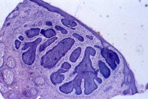 Basal_cell_carcinoma_pathology
