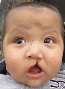 Cleft-lip-and-palate
