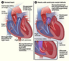Congenital-heart-defects