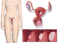 Endometrial-Cancer