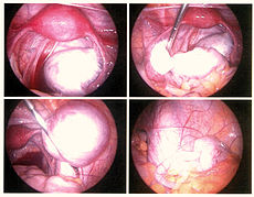 Endometriosis