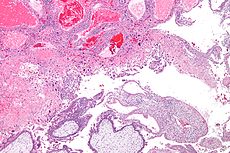 Gestational-trophoblastic-tumor