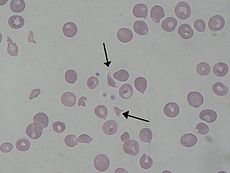 Hemolytic uremic syndrome