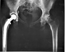 Hip_replacement