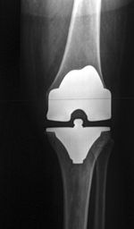 KneeReplacement