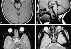 Krabbe-disease