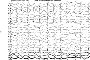 Landau-Kleffner-syndrome