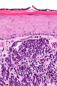 Merkel_cell_carcinoma