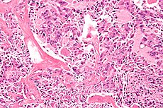 Multiple-endocrine-neoplasia