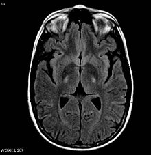 Primary-lateral-sclerosis-01
