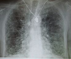 Pulmonary_fibrosis