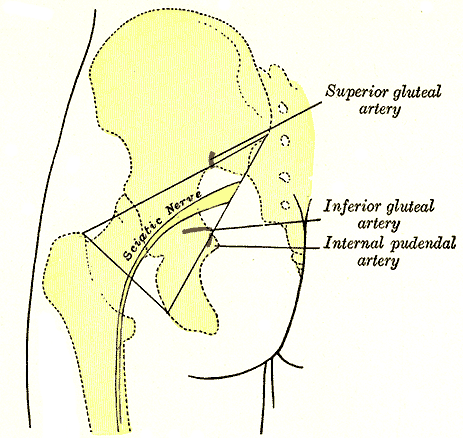 Sciatica