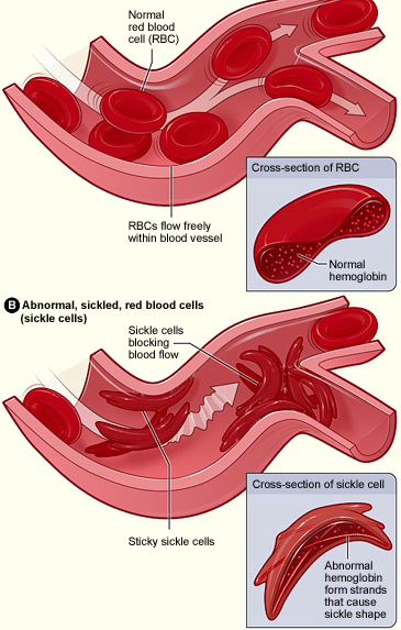 Sickle cell anemia