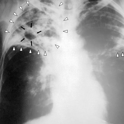 Tuberculosis