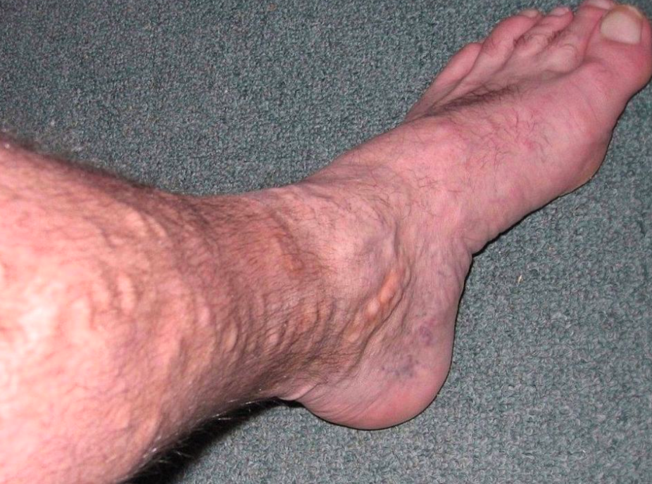 Varicose Veins