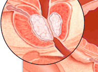 Pulmonary_fibrosis