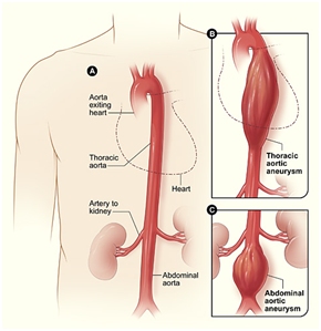 aortic_aneurysm