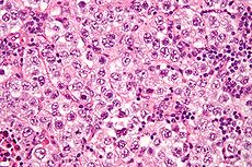 e-germ-cell-tumor