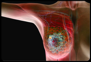 inflammatory-breast-cancer