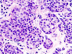 invasive_lobular_carcinoma