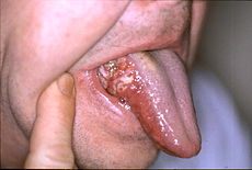 oral-cancer