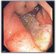 peptic_ulcer